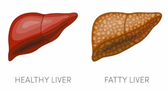 ఫ్యాటీ లివర్‌ సమస్యను తగ్గించుకోవాలంటే.. ఇలా చేయాలి..!