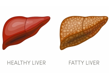 reduce fatty liver problem in these ways