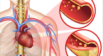 Cholesterol : శ‌రీరంలో కొలెస్ట్రాల్ ఎక్కువ‌గా ఉంటే ఎలాంటి సూచ‌న‌లు, ల‌క్ష‌ణాలు క‌నిపిస్తాయో తెలుసా ?