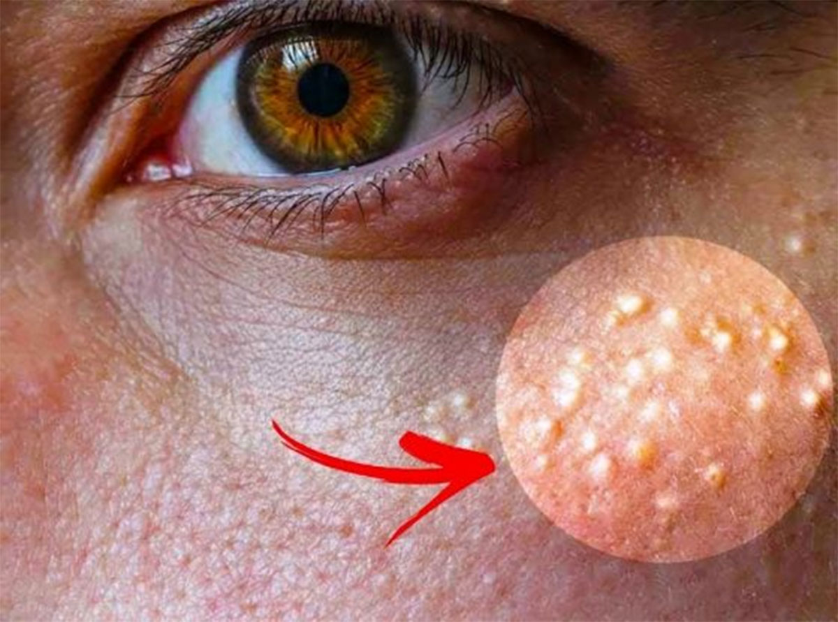 Cholesterol : శరీరంలో కొలెస్ట్రాల్ ఎక్కువగా ఉంటే ఎలాంటి సూచనలు, లక్షణాలు కనిపిస్తాయో తెలుసా ?