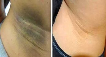 Armpits Darkness : చంక‌ల్లో న‌ల్ల‌గా ఉందా ? ఆ న‌లుపుద‌నం పోయి తెల్ల‌గా, అందంగా మారాలంటే.. ఈ చిట్కాల‌ను పాటించండి..!