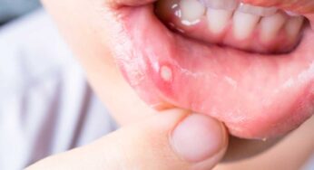 Mouth Ulcer : నోట్లో పుండ్లు ఉన్నాయా ? ఇలా చేస్తే ఒక్క రోజులోనే త‌గ్గిపోతాయి..!