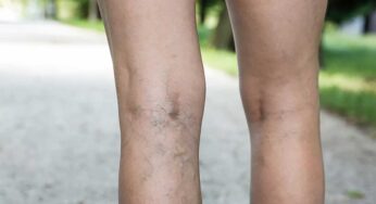 Varicose Veins : కాళ్ల‌లోని ర‌క్త‌నాళాల్లో ర‌క్తం గ‌డ్డ క‌ట్టేది.. ఇందుకే..!