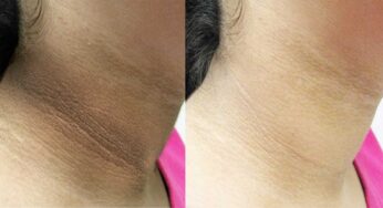 Beauty Tips : మెడ‌, మోచేతులు, మోకాళ్లపై ఉండే న‌లుపుద‌నాన్ని త‌క్ష‌ణ‌మే పోగొట్టే చిట్కా..!