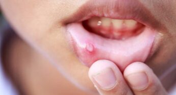 Mouth Ulcer : నోట్లో పుండ్లు, కురుపులు, నోటిపూత‌.. అన్నింటికీ ఇలా చెక్ పెట్టండి..!