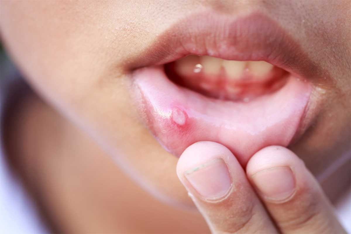 Mouth Ulcer : నోట్లో పుండ్లు, కురుపులు, నోటిపూత.. అన్నింటికీ ఇలా చెక్ పెట్టండి..! best home remedies for Mouth Ulcer