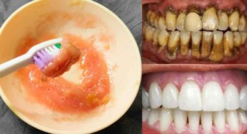 Teeth White : గార ప‌ట్టిన దంతాల‌ను తెల్ల‌గా మార్చే చిట్కా.. రోజూ చేస్తే దంతాలు తెల్ల‌గా మారుతాయి..!