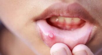 Mouth Ulcer : నోట్లు పుండ్లు, నంజు కురుపులు ఉంటే.. ఇలా సుల‌భంగా త‌గ్గించుకోవ‌చ్చు..!