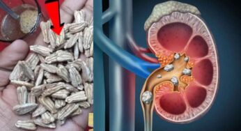 Kidney Stones : మూత్ర పిండాల్లోని రాళ్ల‌ను బ‌య‌ట‌కు పంపే చిట్కా.. చాలా బాగా ప‌నిచేస్తుంది..