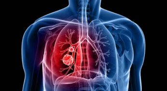 Lung Cancer : ఊపిరితిత్తుల క్యాన్స‌ర్ ఎవ‌రికి వ‌స్తుంది.. కార‌ణాలు ఏంటి.. ఎలా గుర్తించాలి.. నివార‌ణ చ‌ర్య‌లు ఏమిటి..?