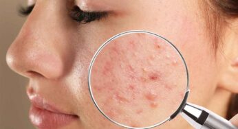 Pimples : ఈ చిట్కాల‌ను పాటిస్తే.. మొటిమ‌లు అనేవి ముఖంపై ఉండ‌వు.. మళ్లీ రావు..!