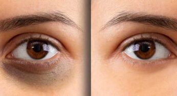 Dark Circles : క‌ళ్ల కింద ఉండే న‌ల్ల‌ని వ‌ల‌యాల‌ను తొల‌గించే.. అద్భుత‌మైన చిట్కాలు..!