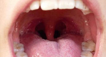 Swollen Uvula Home Remedies : కొండ నాలుక వాపు వ‌చ్చిందా.. పొడ‌వుగా పెరిగిందా.. ఈ చిట్కాల‌ను పాటిస్తే త్వ‌ర‌గా త‌గ్గిపోతుంది..