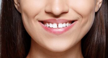 Teeth Gaps : దంతాల మ‌ధ్య సందులు ఉంటే అదృష్టం క‌ల‌సి వ‌స్తుందా.. ఏం జ‌రుగుతుంది..?