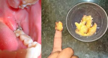 Teeth Pain Remedy : ఈ చిట్కాను పాటిస్తే.. దంతాల నొప్పి త‌గ్గుతుంది.. గార‌పోయి దంతాలు మెరుస్తాయి..