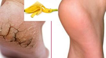 Banana Peel For Cracked Heels : పాదాల ప‌గుళ్ల‌ను త‌గ్గించేందుకు అర‌టి తొక్క ఎంతో ఉప‌యోగ‌ప‌డుతుంది.. ఎలా వాడాలంటే..?