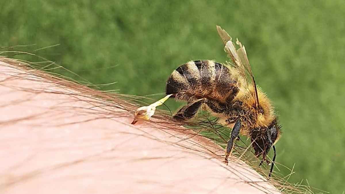 Honey Bees Sting తేనెటీగ‌లు కుట్టిన‌ప్పుడు ఇలా చేయాలి.. నొప్పి, మంట