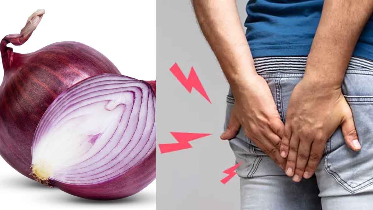 Onions For Piles ఉల్లిపాయ‌ల‌తో ఇలా చేయండి.. పైల్స్ స‌మ‌స్య‌కు శాశ్వ