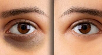 Dark Circles : క‌ళ్ల కింద న‌ల్ల‌ని వ‌ల‌యాల‌ను త‌గ్గించే అద్భుత‌మైన చిట్కా.. ఏం చేయాలంటే..?