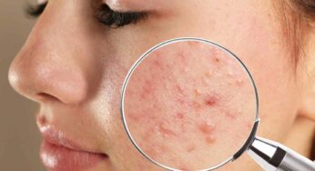 Pimples : ఇలా చేస్తే మొటిమ‌లు అన్నీ మాయం అవుతాయి.. అద్భుతంగా పనిచేస్తుంది..
