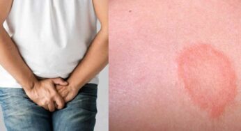 Skin Infection : తొడ‌లు, గ‌జ్జ‌ల్లో ఇలా దుర‌ద‌లు వ‌స్తూ.. ఇన్‌ఫెక్ష‌న్లు ఉంటే.. ఇలా చేయండి.. దెబ్బ‌కు పోతాయి..!