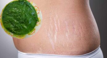 Stretch Marks : స్ట్రెచ్ మార్క్స్‌పై దీన్ని రాస్తే చాలు.. చ‌ర్మం పూర్తిగా మారిపోతుంది..