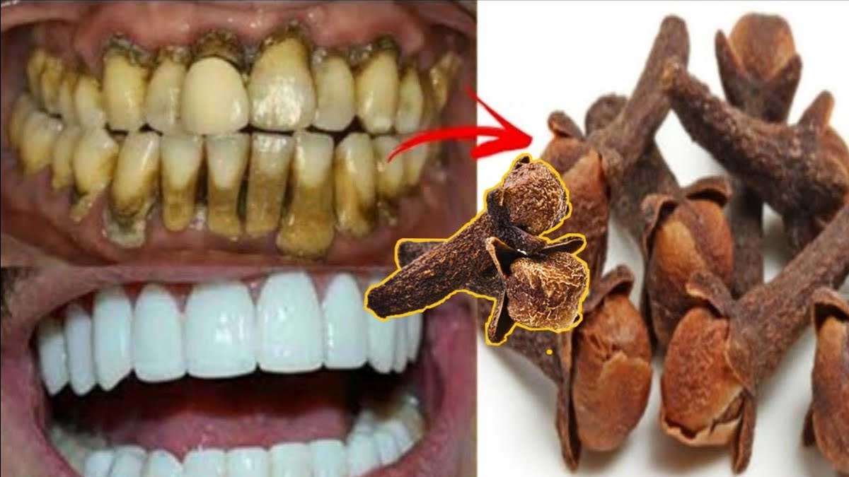 Cloves For Teeth ల‌వంగాల‌తో ఇలా చేస్తే చాలు.. ఎంత‌టి ప‌సుపు దంతాలు