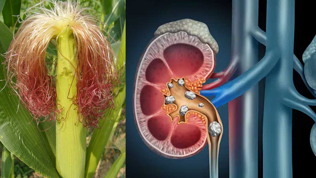 Corn Silk For Kidney Stones మొక్క‌జొన్న పీచుతో ఇలా చేస్తే చాలు