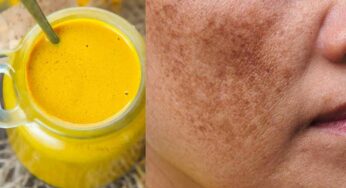 Pigmentation : ముఖంపై ఉండే మంగు మ‌చ్చ‌ల‌ను పోగొట్టే అద్భుత‌మైన చిట్కా.. ఇలా చేయాలి..!