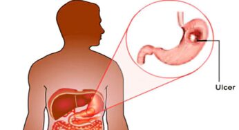 Ulcer : ఈ ల‌క్ష‌ణాలు క‌నిపిస్తున్నాయా.. అయితే అల్స‌ర్ ఉన్న‌ట్లే..!