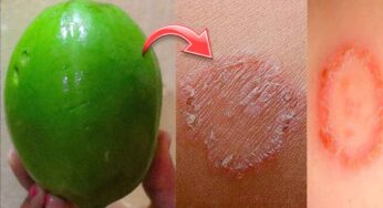 Fungal Infections : తామర, గజ్జి లాంటి చర్మ వ్యాధుల నుంచి 5 రోజుల్లో ఇలా బయటపడండి..!