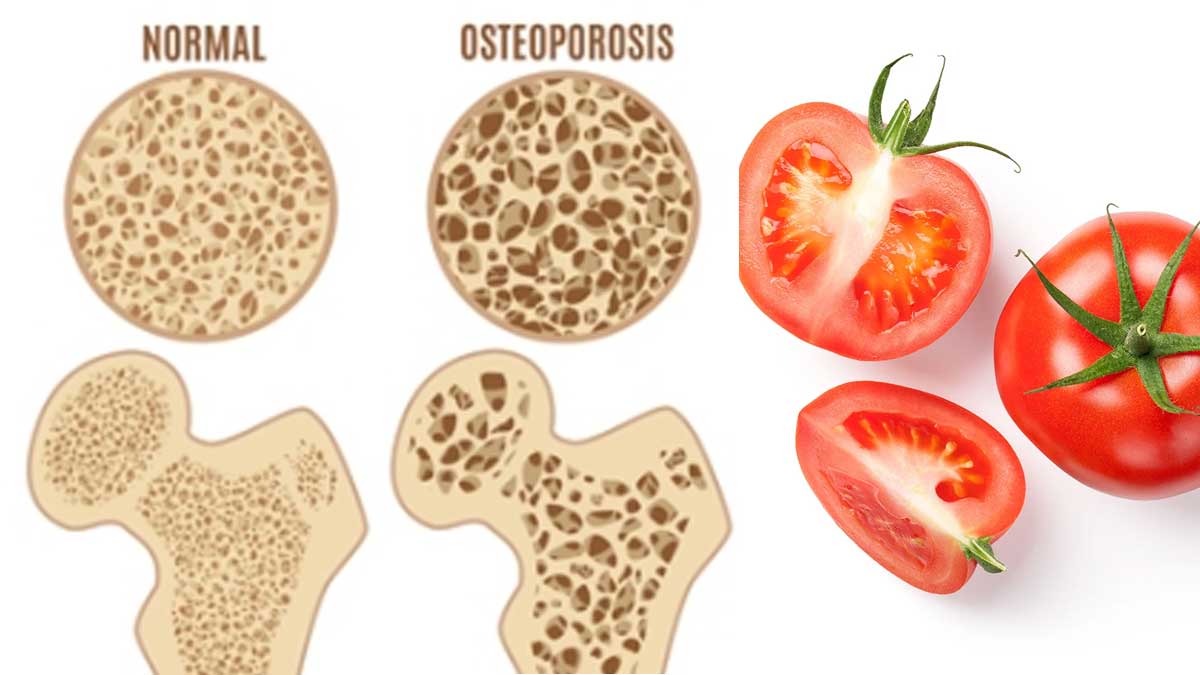 Tomato For Osteoporosis రోజుకు ఒక్క టమాటాతో ఇలా చేస్తే చాలు.. ఎముకలు