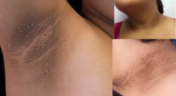 Darkness On Neck And Armpits : మెడ‌, చంక‌లు, గ‌జ్జ‌ల్లో చ‌ర్మం న‌ల్ల‌గా మారిందా.. దీనికి అస‌లు కార‌ణాలు ఇవే..!