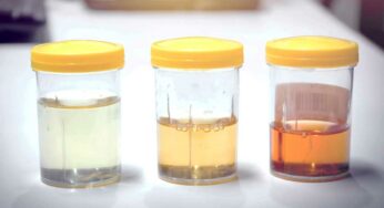 Urine Color And Diseases : మూత్రం క‌ల‌ర్‌ను బ‌ట్టి మీకొచ్చే డేంజ‌ర్ వ్యాధులు ఇవే.. ఏం చేయాలి..?