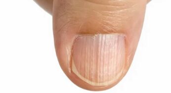 White Lines On Nails : మీకు ఇలా ఉందా.. నిర్ల‌క్ష్యం చేస్తే భారీ మూల్యం చెల్లించాల్సి వ‌స్తుంది..!