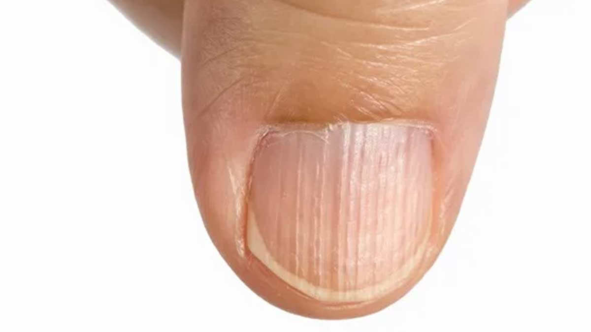 White lines on nails | Lines on nails, White lines on nails, Nails