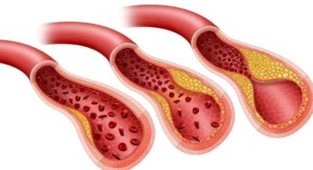 Plaque In Arteries : వీటిని తీసుకుంటే చాలు.. బీపీ ఎంత ఉన్నా త‌గ్గిపోతుంది.. ర‌క్త‌నాళాల్లో కొలెస్ట్రాల్ అస‌లే ఉండ‌దు..!