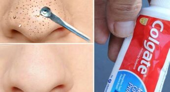 Toothpaste For Blackheads : టూత్‌పేస్ట్‌, ఉప్పుతో ఇలా చేస్తే.. బ్లాక్ హెడ్స్ అస‌లే ఉండ‌వు..!