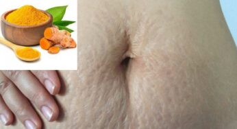 Turmeric For Stretch Marks : ప‌సుపుతో ఇలా చేస్తే చాలు.. స్ట్రెచ్ మార్క్స్ అస‌లే ఉండ‌వు..!