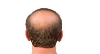 Bald Head Reasons : పురుషుల‌కు అస‌లు బ‌ట్ట‌త‌ల ఎందుకు వ‌స్తుంది.. దీని వెనుక ఉన్న కార‌ణాలు ఏమిటి..?