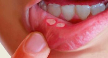 Mouth Ulcer Home Remedies : నోటిపూత‌, నోట్లో పుండ్ల‌కు ఇంటి చిట్కాలు.. ఇలా చేయండి చాలు..!