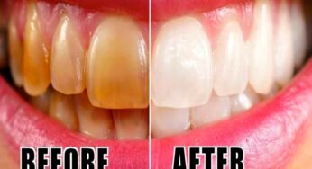 Whiten Teeth Naturally : ఈ చిట్కాల‌ను పాటిస్తూ మీ దంతాల‌ను స‌హ‌జంగానే తెల్ల‌గా మార్చుకోండి..!