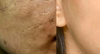 Open Pores On Face : ఇలా చేస్తే చాలు.. ముఖంపై ఎలాంటి గుంట‌లు ఉండ‌వు..!