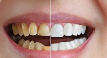 Whiten Teeth : ఈ 10 చిట్కాల‌ను పాటిస్తే చాలు.. ఇంటి ద‌గ్గ‌రే మీ దంతాల‌ను తెల్ల‌గా మార్చుకోవ‌చ్చు..!