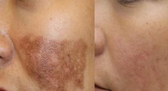 Pigmentation Home Remedies : మంగు మచ్చ‌ల‌ను తొల‌గించుకునేందుకు ఇలా చేయండి.. మ‌ళ్లీ రావు..!