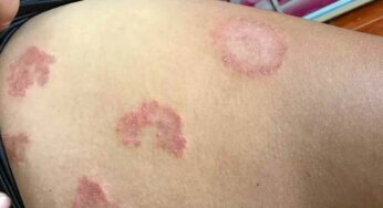 Skin Issues : గ‌జ్జి, తామ‌ర‌, దుర‌ద 2 నిమిషాల్లో మాయ‌మ‌వుతుంది.. మ‌ళ్లీ రాదు.. ఇలా చేయండి..!