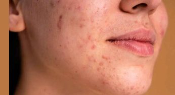 Skin Problems Diet : మీ ముఖంపై మొటిమ‌లు, మ‌చ్చ‌లు ఎక్కువ‌గా వ‌స్తున్నాయా.. అయితే ఈ ఫుడ్స్‌ను తిన‌కండి..!