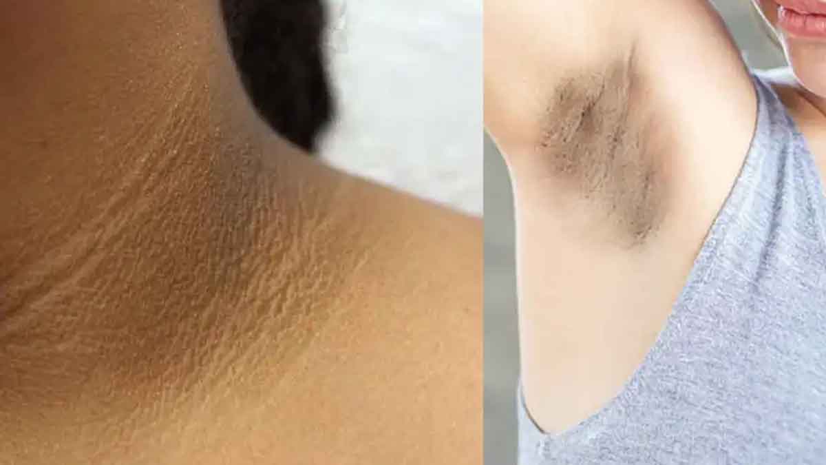 dark neck and armpits home remedies 