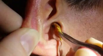 Ear Wax : చెవుల్లో ఏర్ప‌డే గులిమి స్థితిని బ‌ట్టి వ్య‌క్తి ఆరోగ్య స్థితి తెలుసుకోవ‌చ్చిలా..!