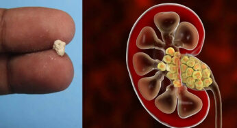 Kidney Stones : మీ కిడ్నీల‌లో రాళ్లు ఉన్నాయో లేదో.. ఈ సింపుల్ ట్రిక్స్ ద్వారా తెల్సుకోండి..